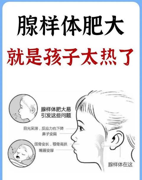 儿童腺样体肥大治疗指南