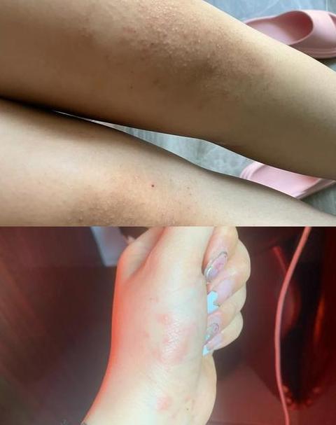 湿疹终结者：亲身经历分享，揭秘湿疹断根秘籍