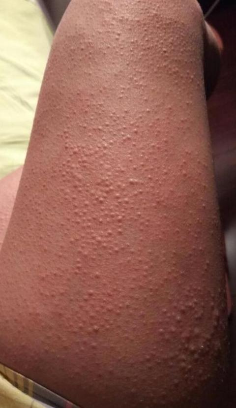 身上一挠起一片片疙瘩